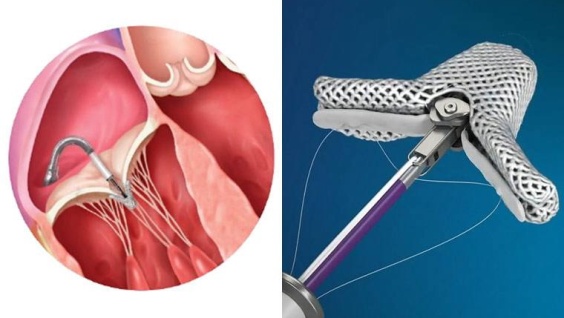 Когда сердце «не держит» клапан: современное лечение митральной недостаточности